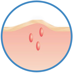 Beurer BR 60 Insect Sting Device for Burning Swelling